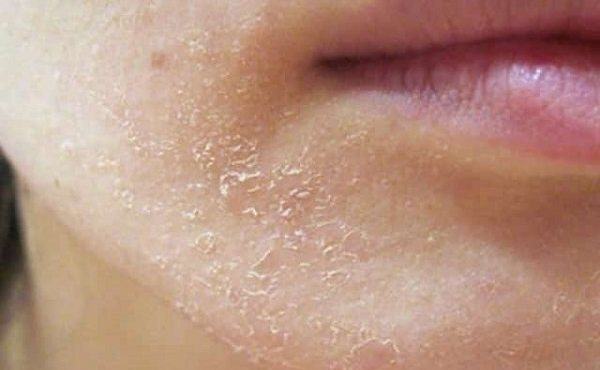 بهترین روش‌های درمان خشکی پوست صورت