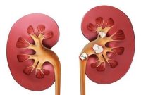 مصرف کم آب علت اصلی ابتلا به سنگ کلیه