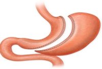 ناگفته ها درمورد عمل پانچ معده که هنوز نمیدانید!