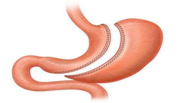 ناگفته ها درمورد عمل پانچ معده که هنوز نمیدانید!