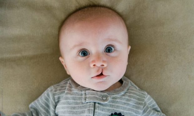 جراحی بینی لب شکری | رینوپلاستی بیماران شکاف لب و کام